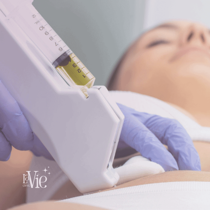 Body Microneedling With Prp La Vie Clinic Rochester Hills