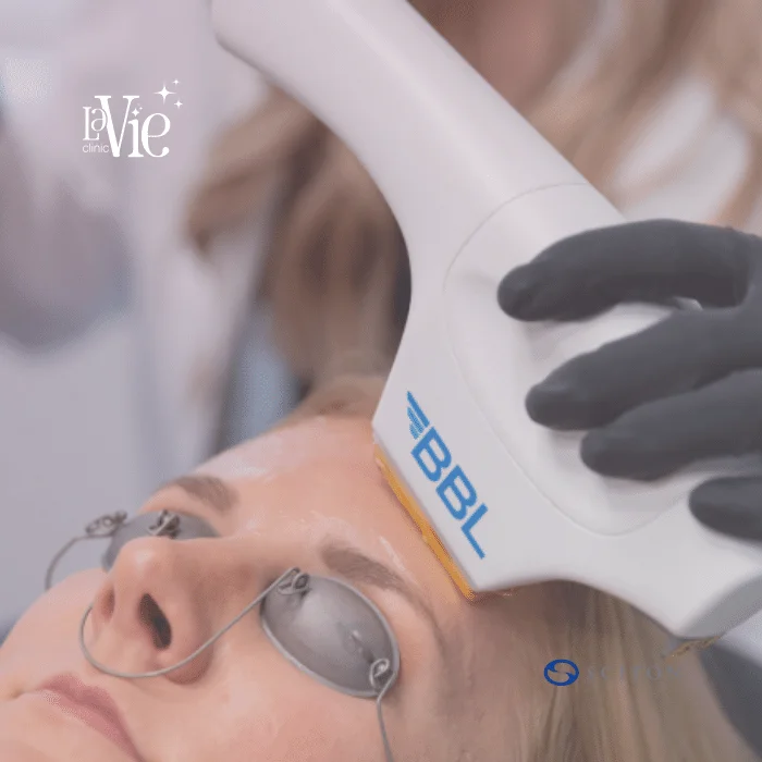 Bbl Laser Treatment La Vie Clinic Rochester Hills