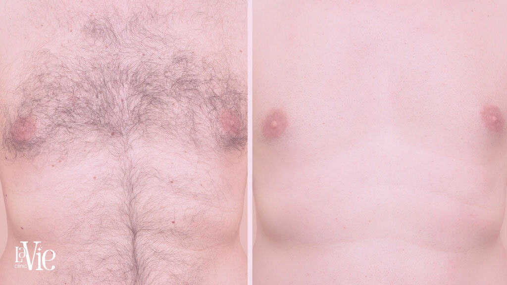 Laser Hair Removal Rochester hills - Before and After results