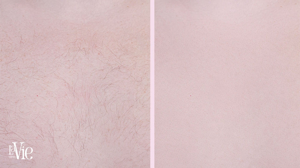 Laser Hair Removal Rochester hills - Before and After results