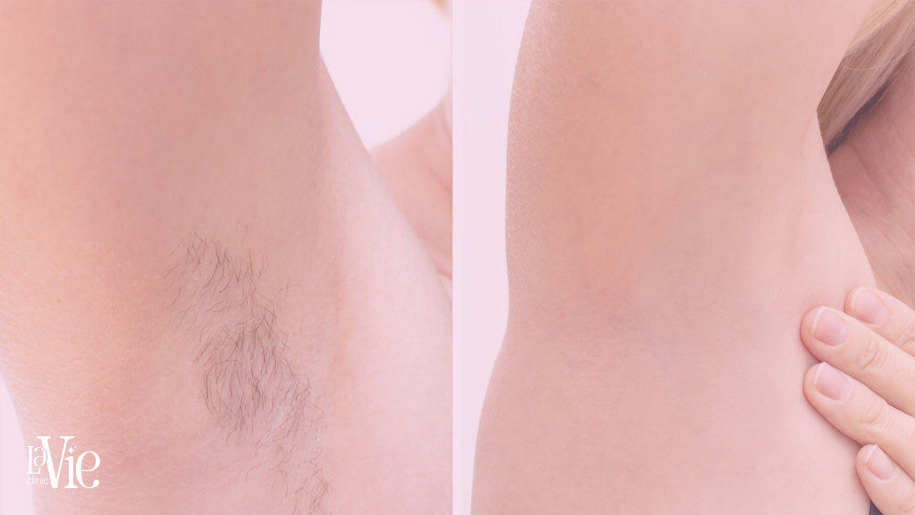 Laser Hair Removal Rochester hills - Before and After results