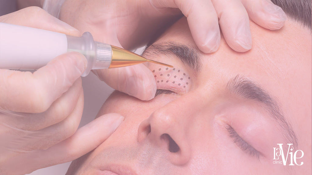 specialist injects Non-Surgical Facelift solution into the eyelid to improve skin texture, offer mild-to-moderate skin tightening effects, result in some degree of skin facial contour change,La Vie Clinic Rochester Hills.