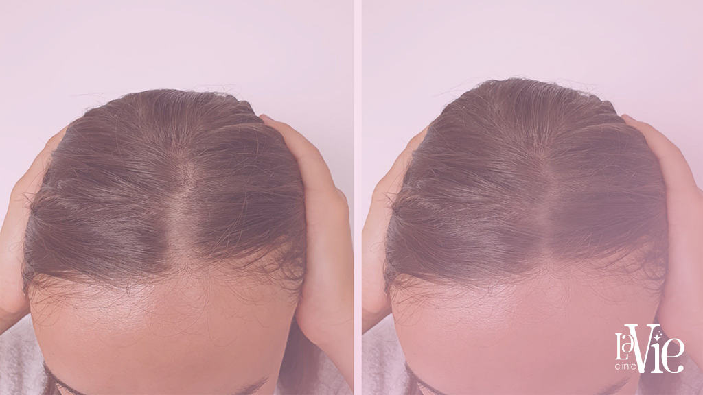 Before and After Your PRF Hair Treatment. La vie aesthetic clinic