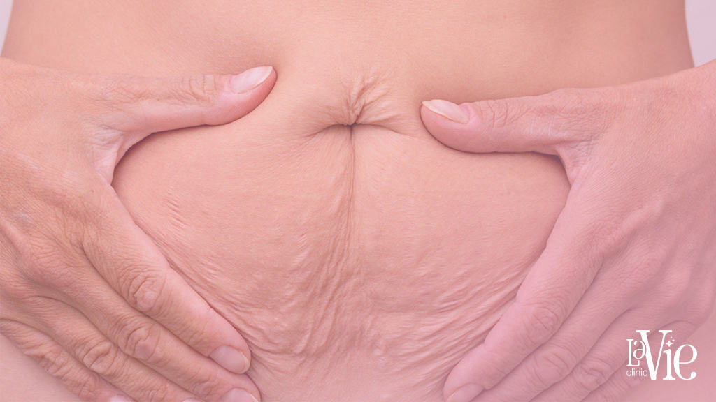 Fibroblast Skin Tightening - wrinkled skin around stomach