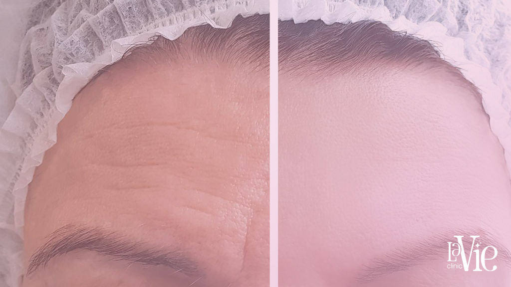 microneedling before and after 1 treatment