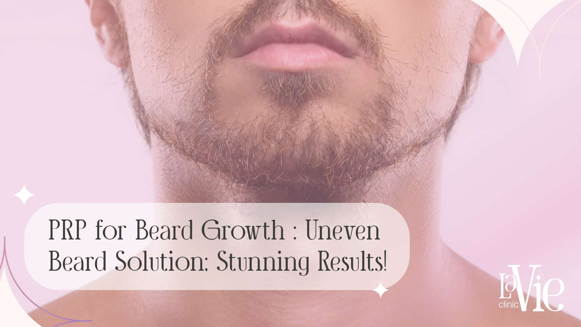 prp-for-beard-growth-solution-stunning-results