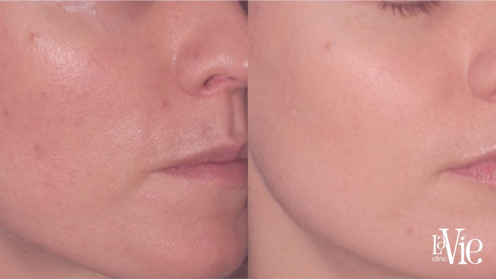 moxi laser before and after
