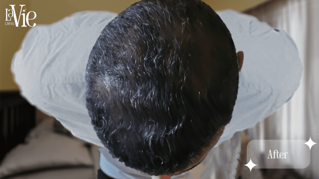 PRP Hair restoration after 6 months - La Vie Med Spa Rochester Hills Mi