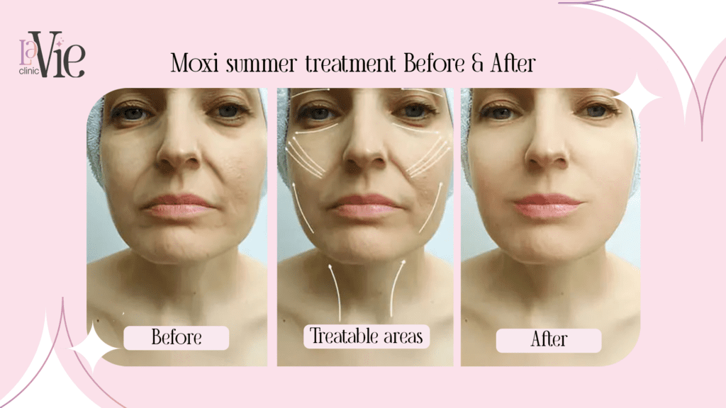 Moxi summer Treatment Before and after