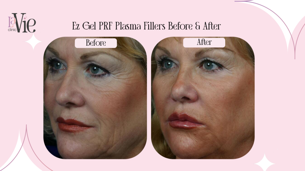 EZ Gel Plasma Filler before and after