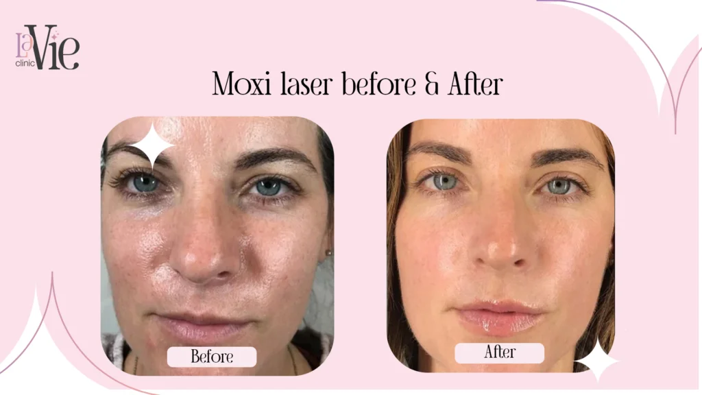 Moxi laser Treatment before and after results