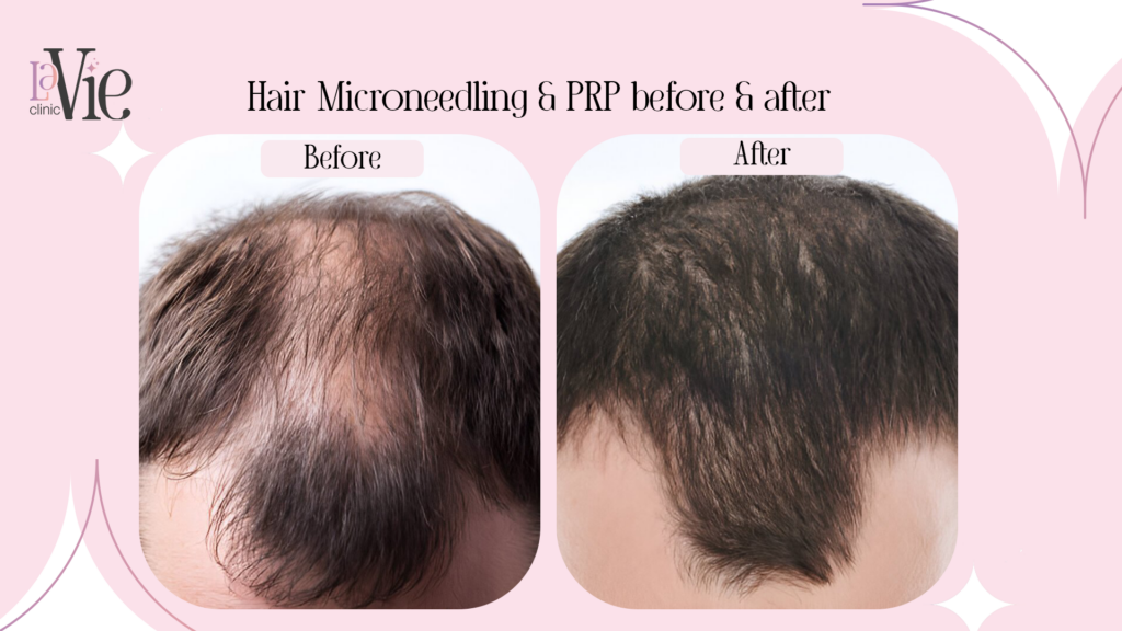 PPR & Microneedling Before and After Results