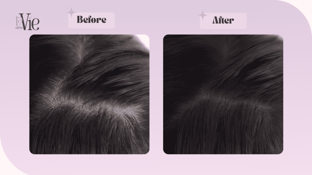 Mesotherapy for Hair before and after results