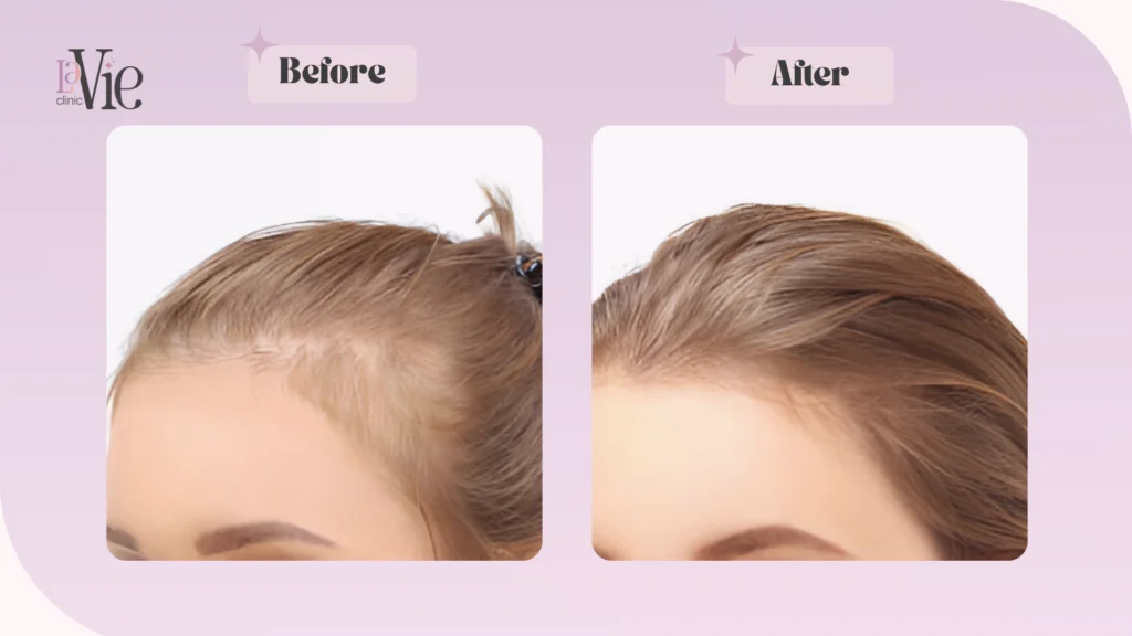 microneedling for hair loss before and after results 