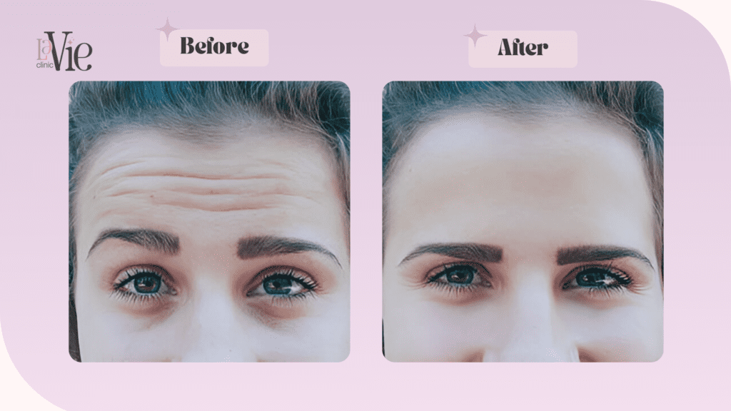 Microtox vs Botox before and after results