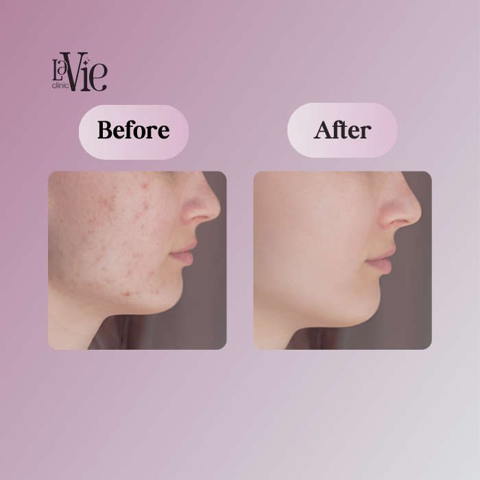 Melasma Treatment - N & R Lavie Clinic