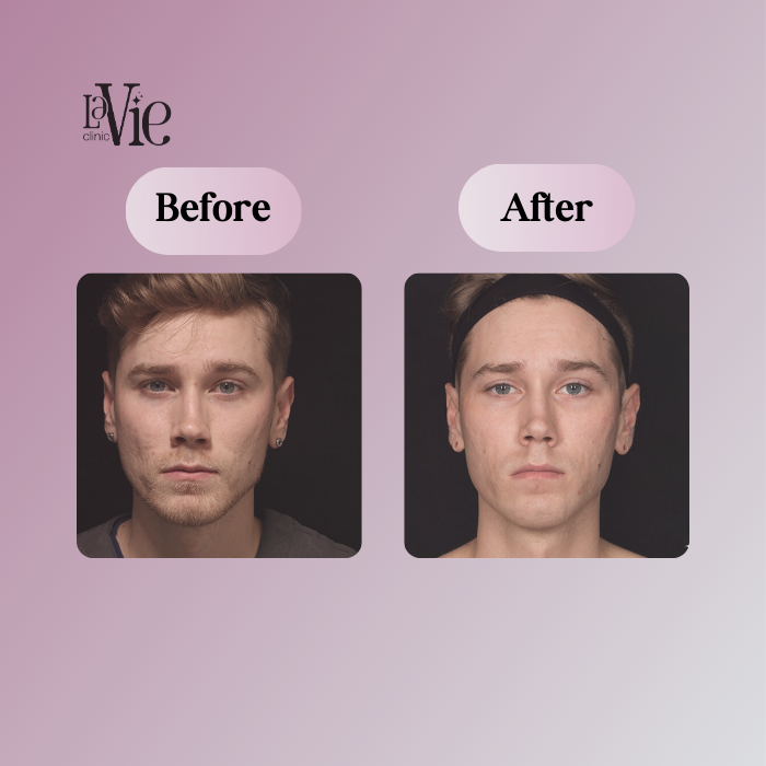 Baby Face Laser Resurfacing for sun damage before and after