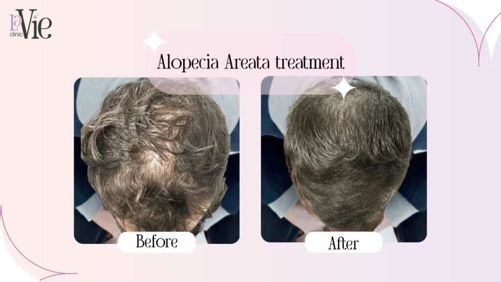 Alopecia Areata treatment