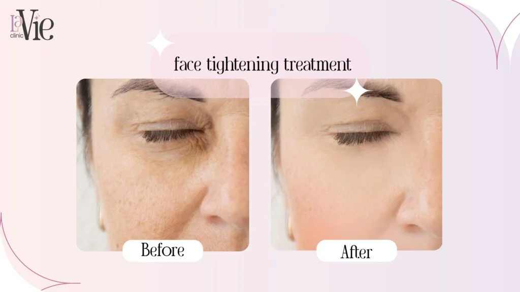 face-tightening-treatment- before and after