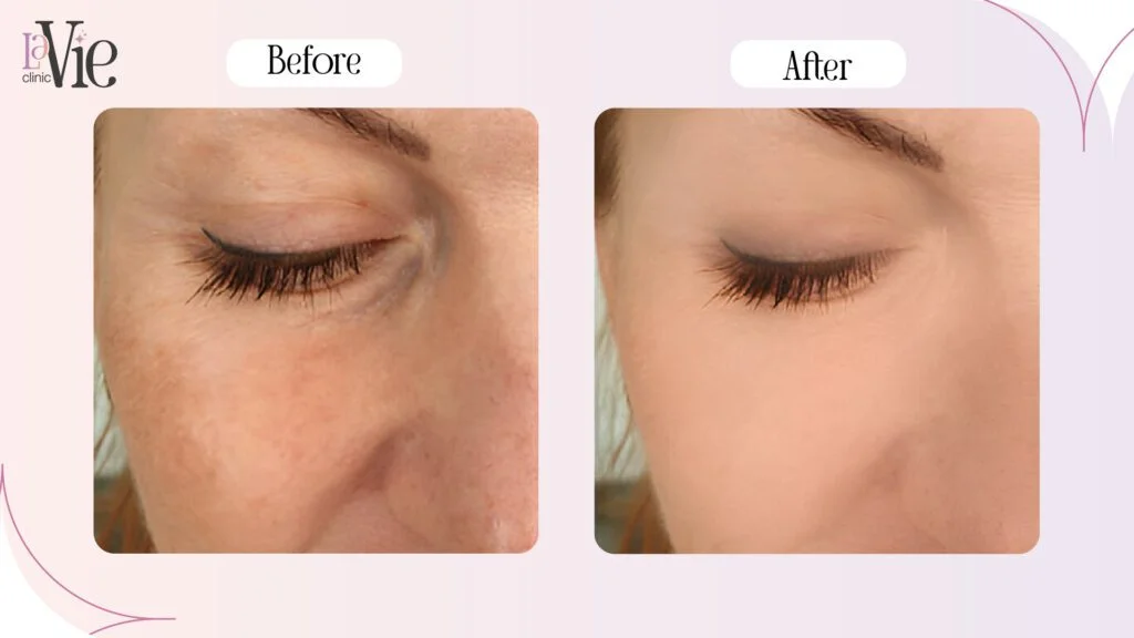 BBl Forever Young treatment before and after results 