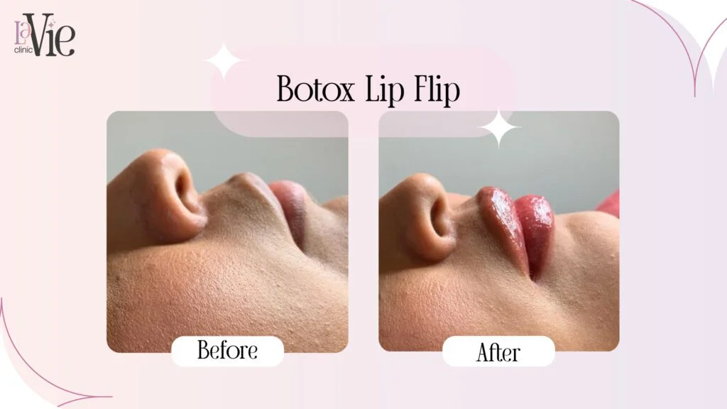 Botox Lip Flip before and after