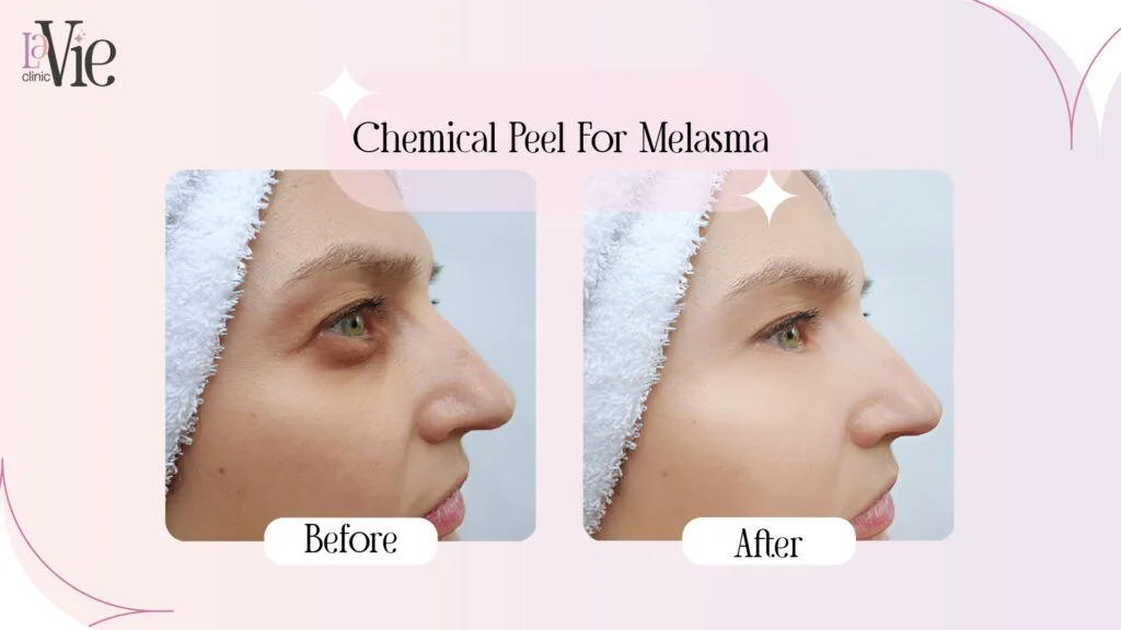 Chemical Peel For Melasma