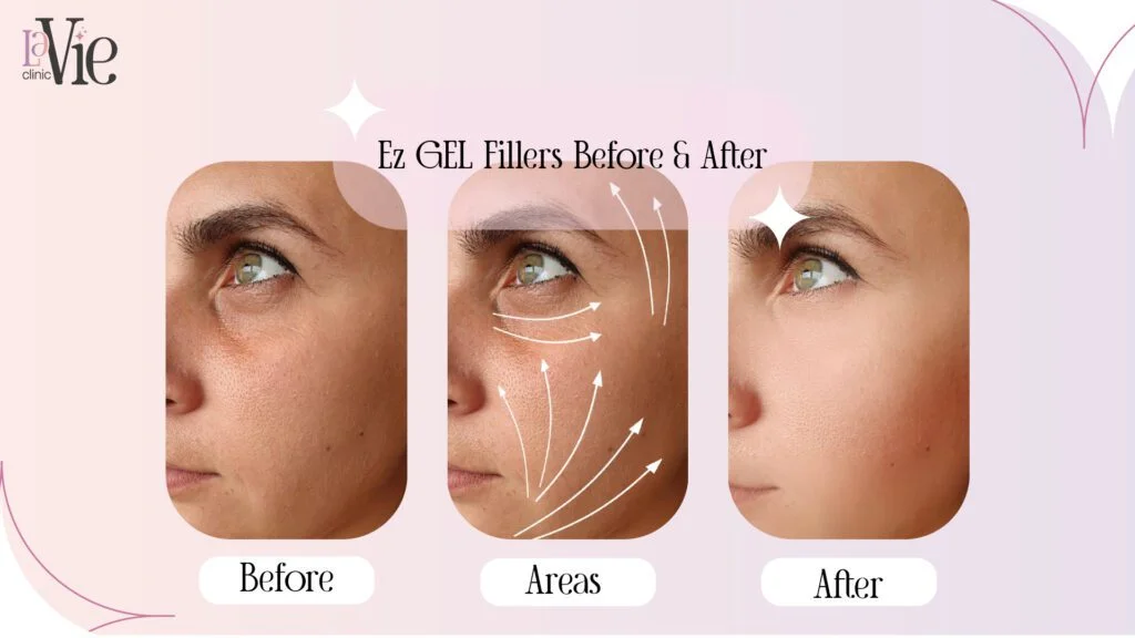 Ez GEL Fillers Before & After