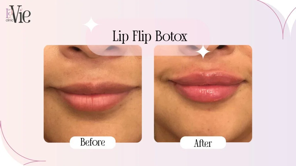 Botox Lip Flip before and after