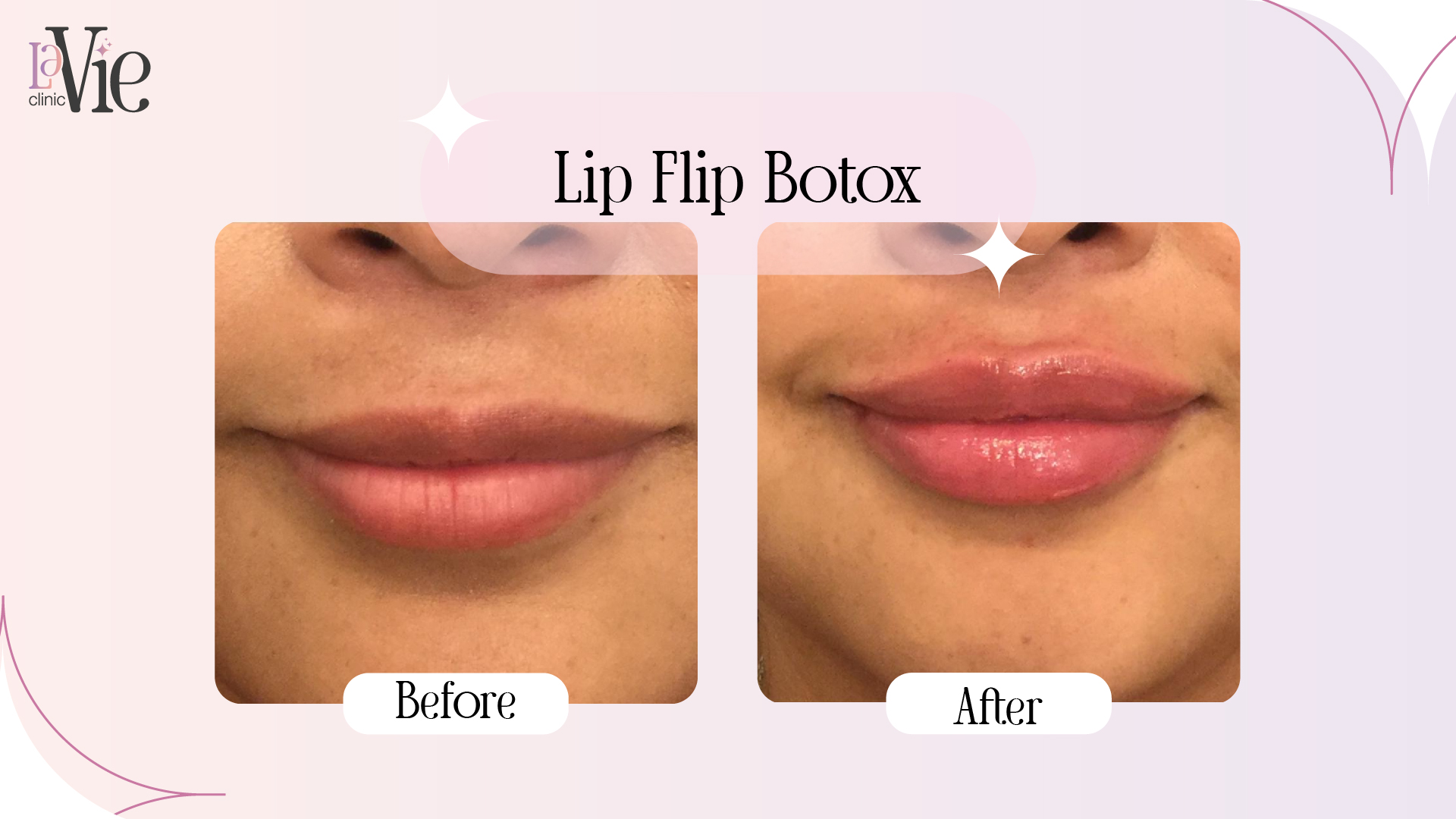 How Botox Lip Flip Refines Your Smile With La Vie Clinic Experts How Botox Lip Flip Refines Your Smile With La Vie Clinic Experts