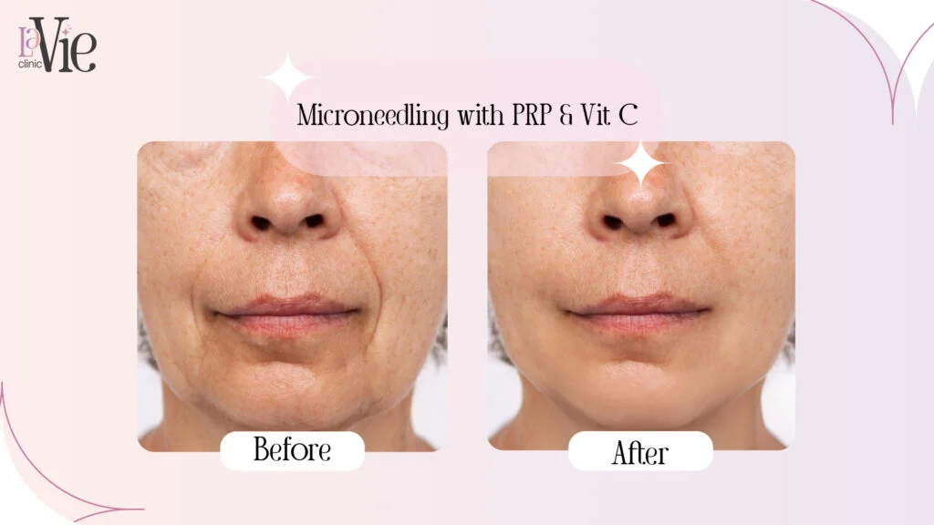 microneedling with prp before and after | La Vie Med Spa