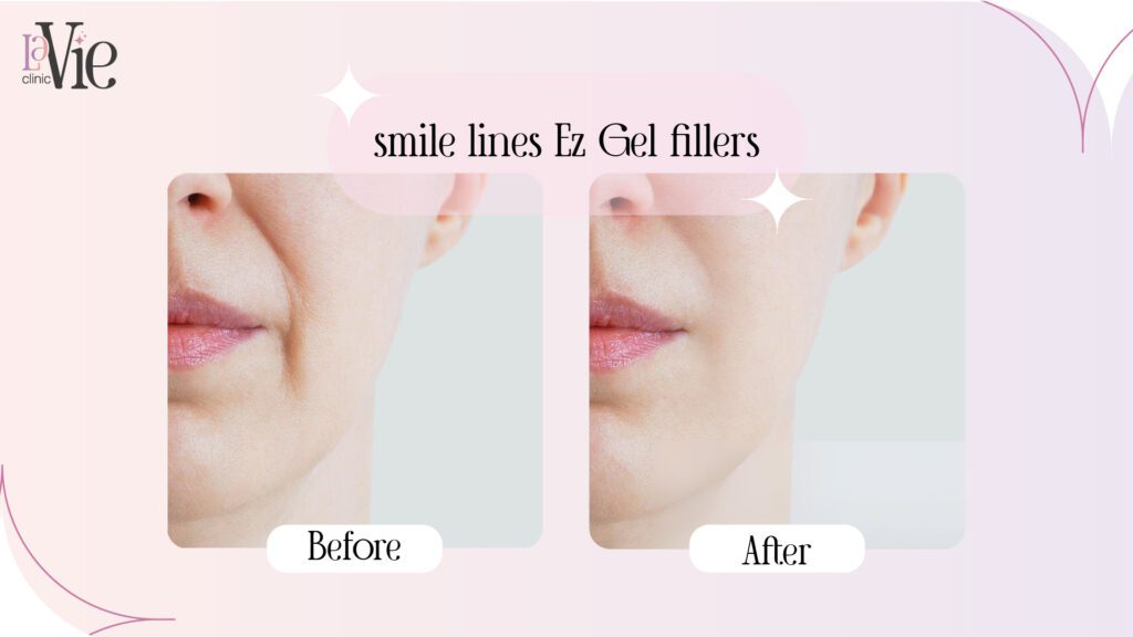 Ez GEL Fillers Before & After