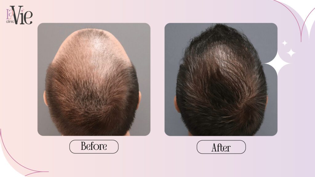 Hair Microneedling & PRP For Hair loss 2