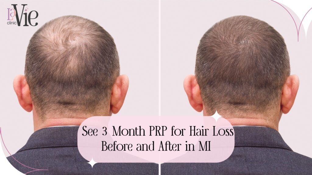 See 3 Month PRP for Hair Loss Before and After in MI