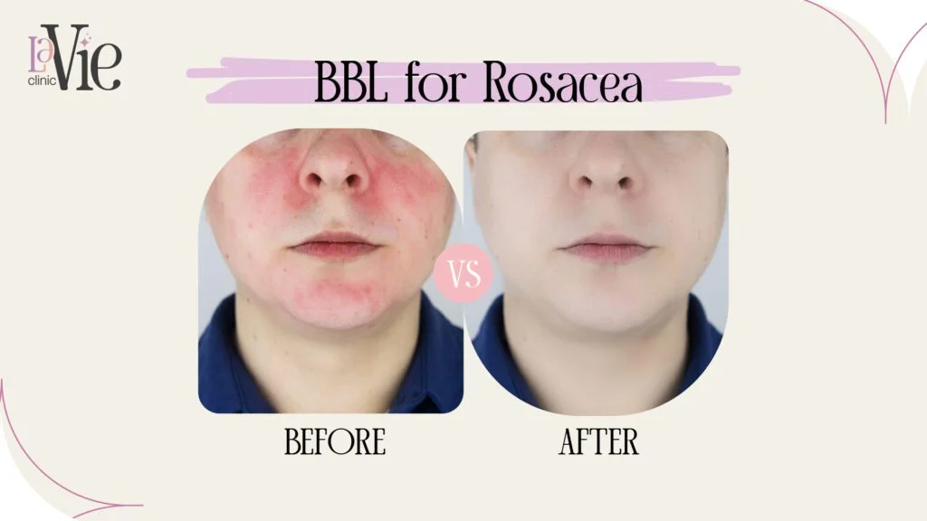 BBL for Rosacea results