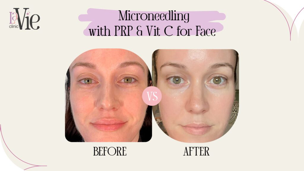 Microneedling with PRP & Vit C for Face